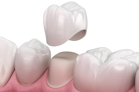 Krunica na prirodnim zubima