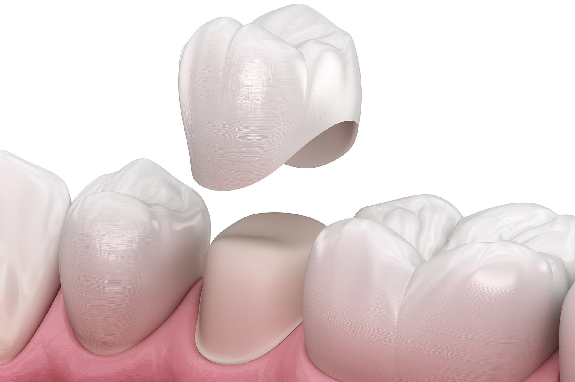 Krunica na prirodnim zubima