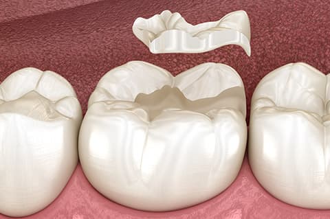 Ispuni od keramike i kompozita