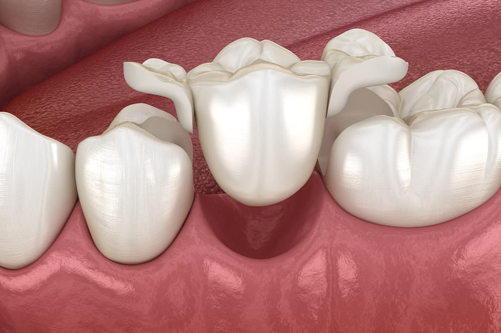 Most na prirodnim zubima