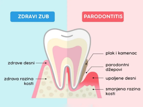 Gingivitis i Parodontitis
